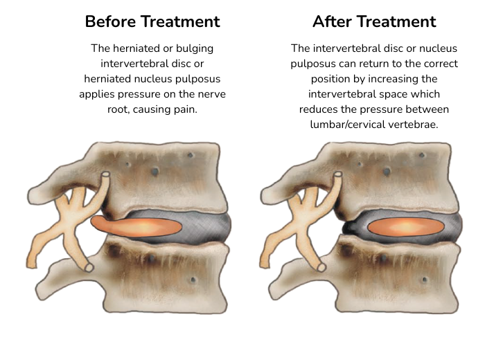 Before & After Spinal Decompression Treatment