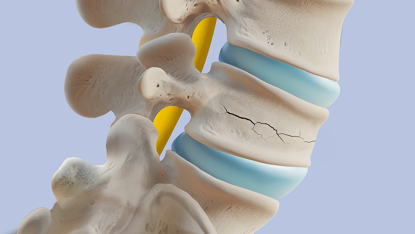 Lumbar compression fracture