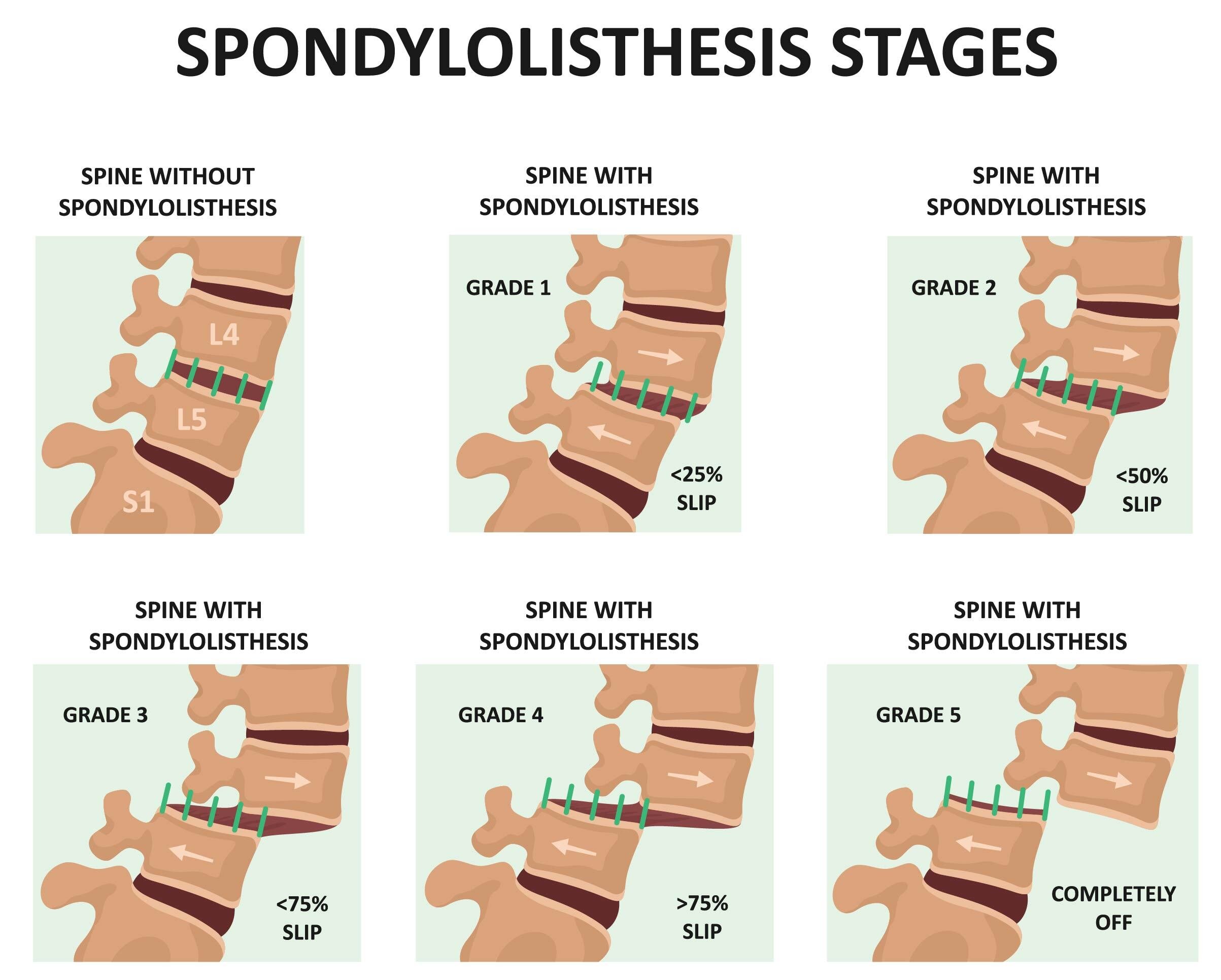 Spondylolisthesis Stages