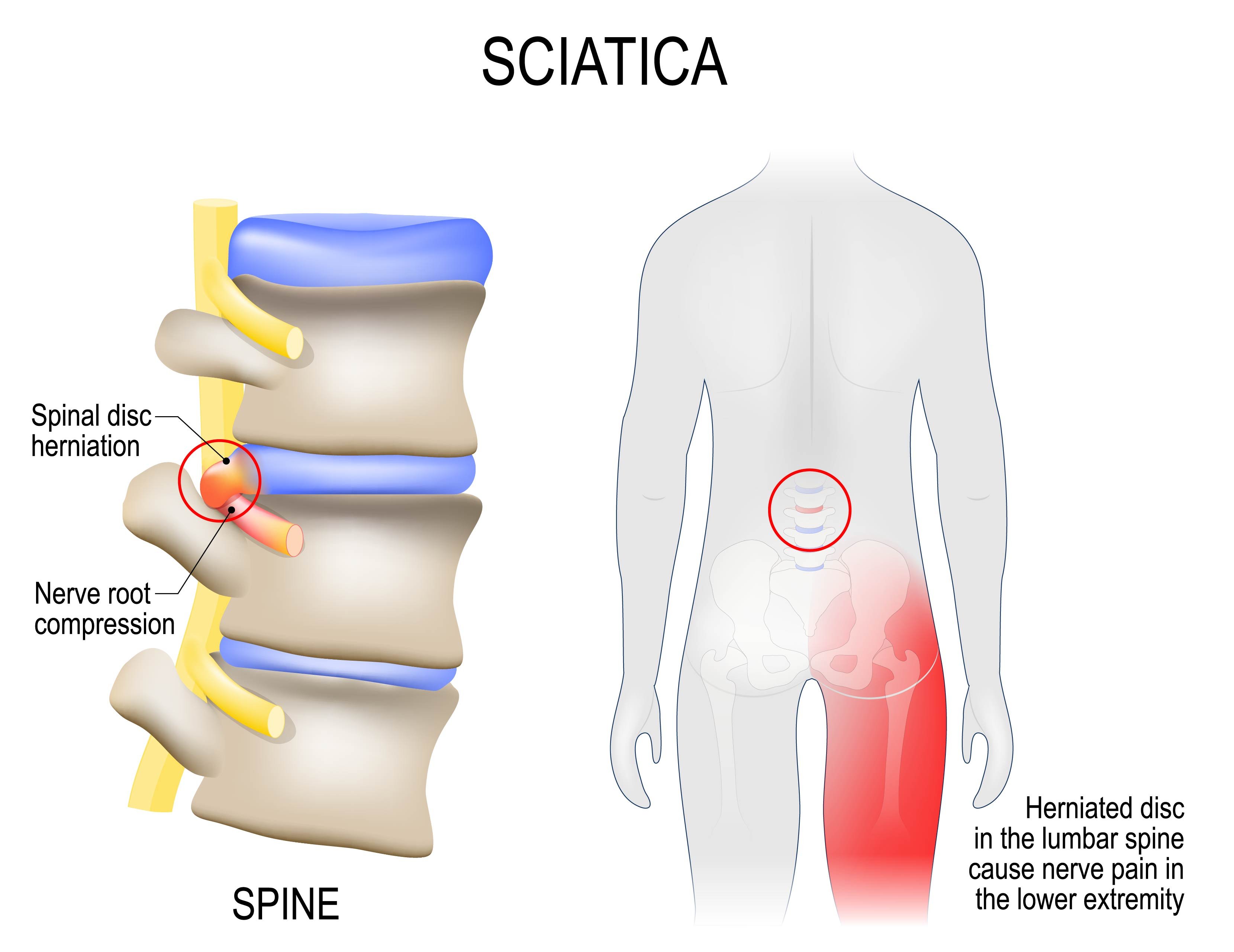 Choosing the Right Back Brace to Help Treat Sciatica