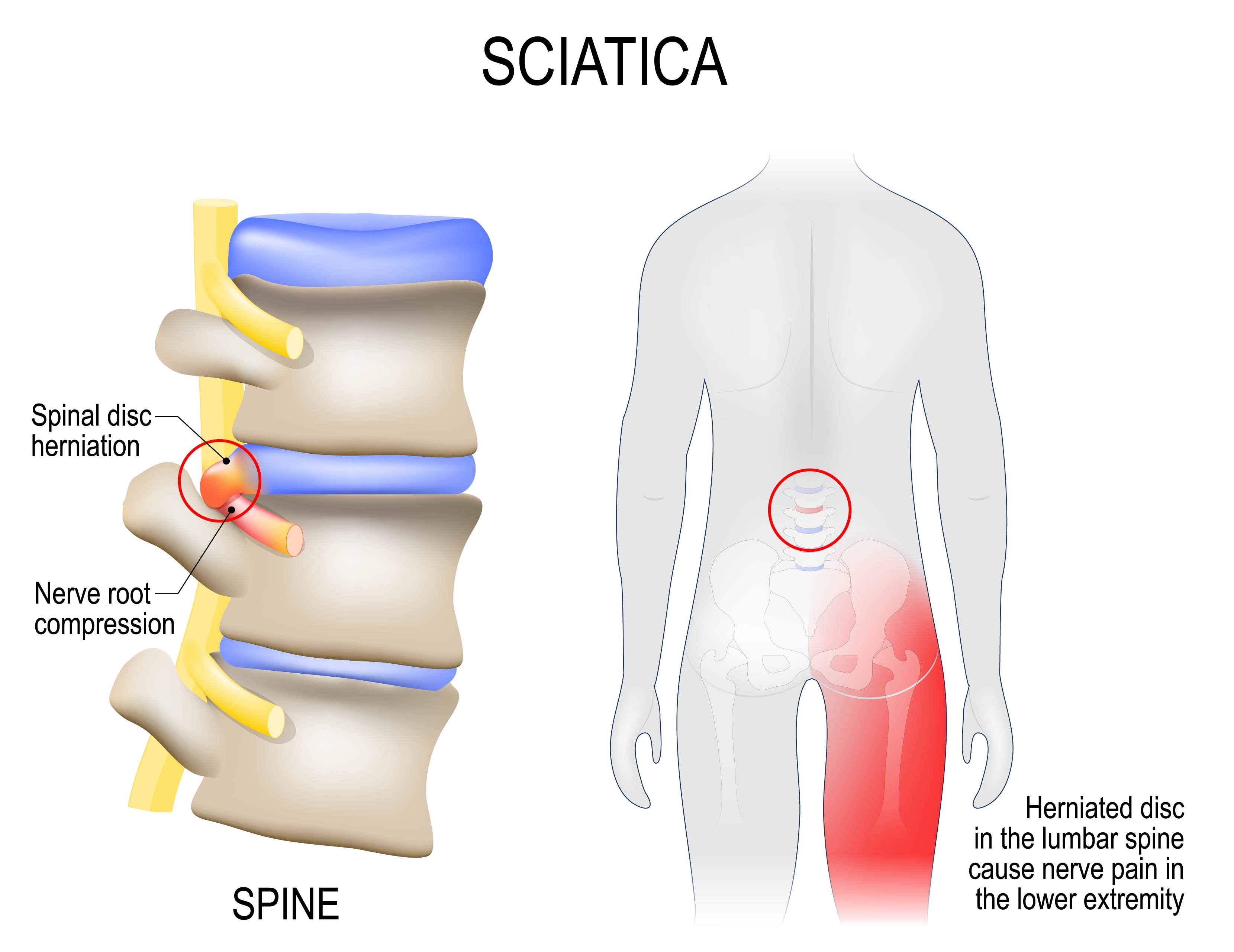 Sciatica Symptoms Including Back Pain and Leg Cramps