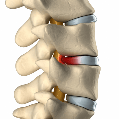 herniated disc pressure on spinal canal