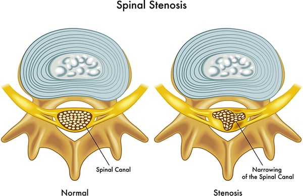 spinal canal stenosis illustration