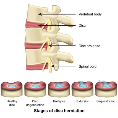stages of disc herniation