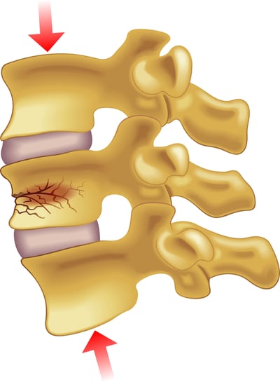 vertebral fracture