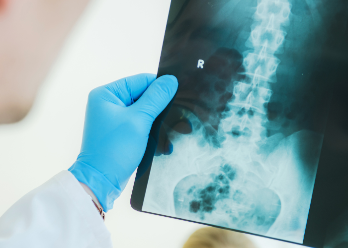 Understanding Lumbar Compression Fractures