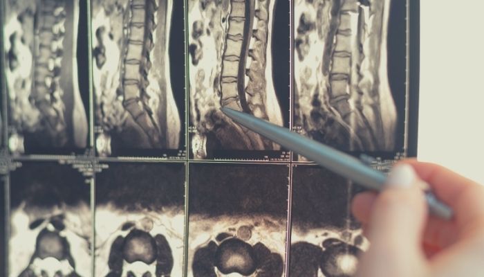 What is Spinal Stenosis, and How is it Treated?